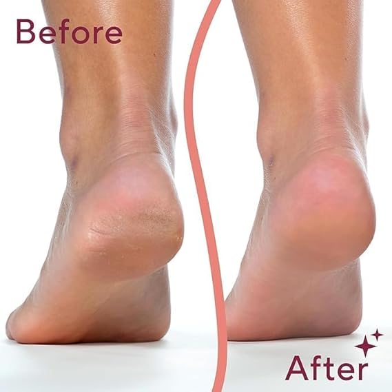 Callus Remover For Feet Dead Skin Remover